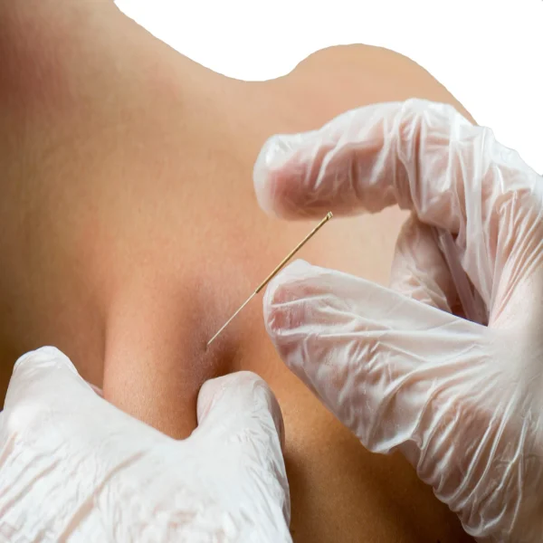 dry-needling